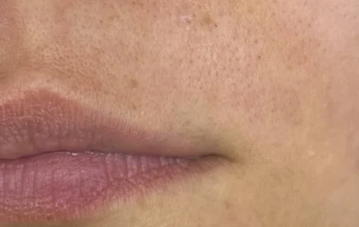 The same facial area after four laser hair removal sessions