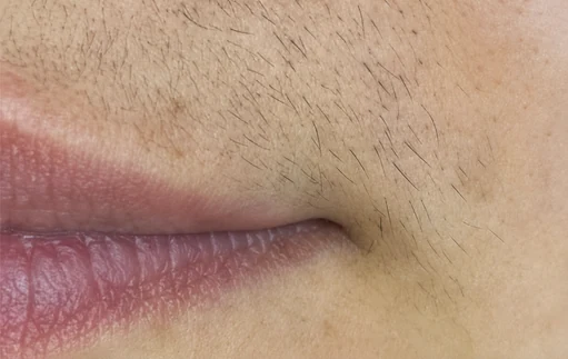 Facial hair before a four-session laser hair removal series